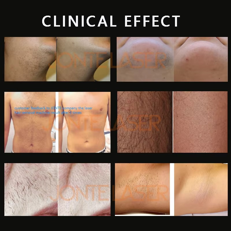 Taşınabilir Profesyonel 1200W  - Diode Laser Hair Removal 808Nm 755Nm 1064Nm incelemesi ve fiyatı