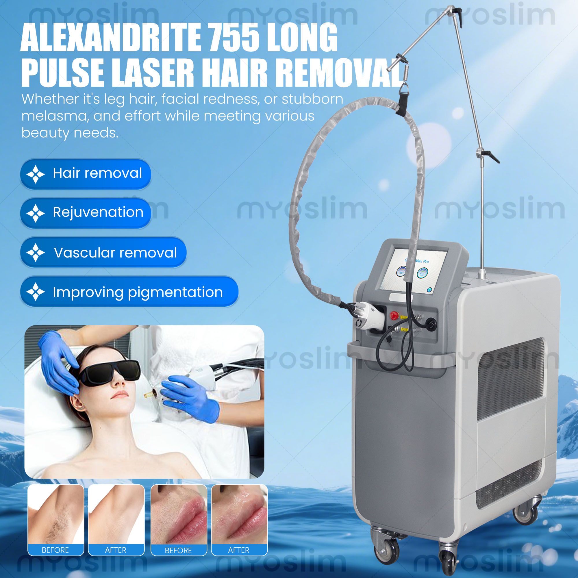 755nm 1064nm Uzun Darbeli Alek - Alexandrite Laser Hair Removal Machine incelemesi ve fiyatı