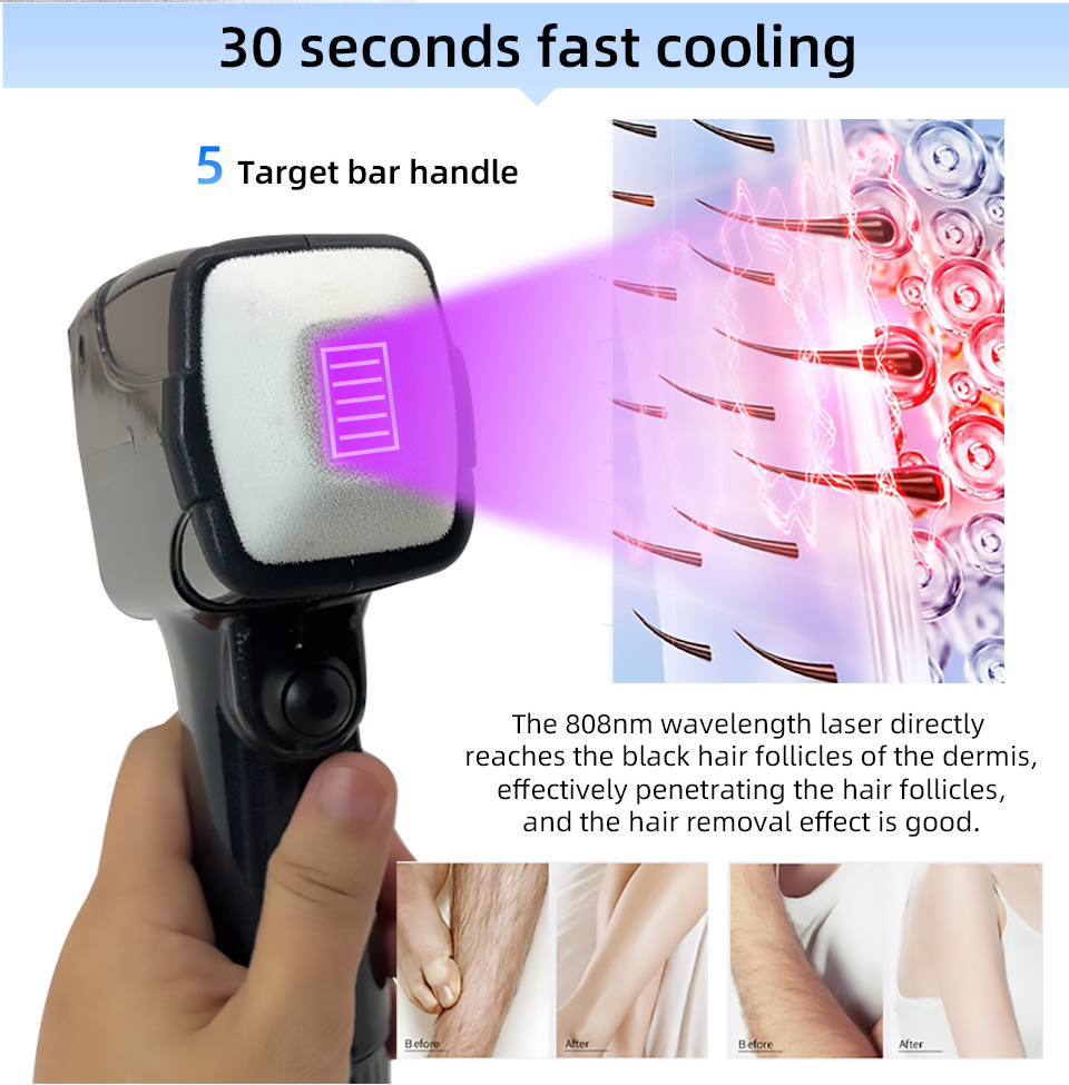 Yeni Stil Taşınabilir 808 NM D - Alexandrite Laser Hair Removal Machine incelemesi ve fiyatı